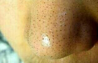 要是你有黑头,粉刺,豆豆,毛孔粗大,暗黄,斑点,脂